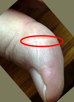Thumb Scar Marked.JPG