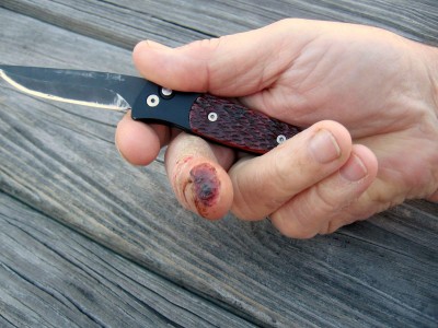Missing Finger Tip.JPG