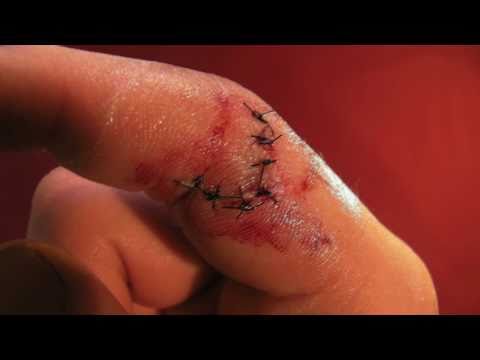 Balisong accident.jpg