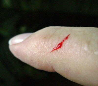 Bulldog Bit Finger.JPG