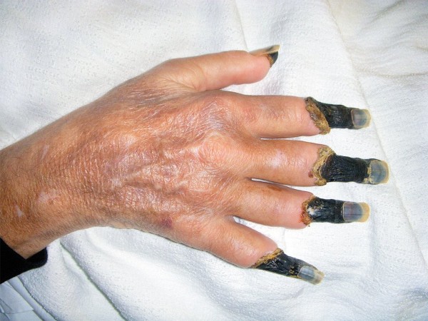 gangrene-distal.jpeg (1).jpg