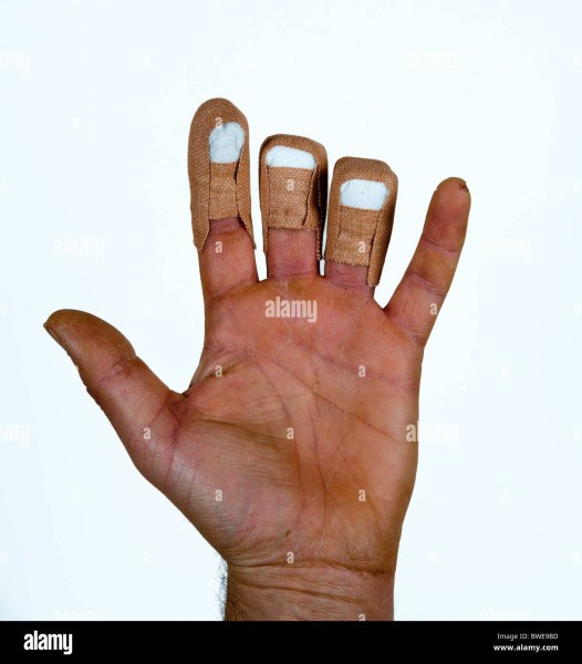 male-close-up-of-left-hand-on-white-background-missing-two-fingers-BWE9BD.jpg