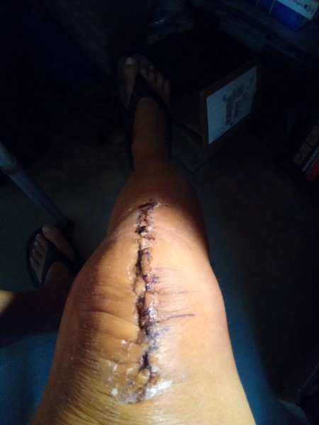Bandage removed by nurse yesterday.