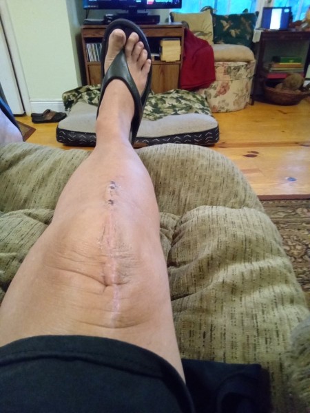 3 small scabs remaining