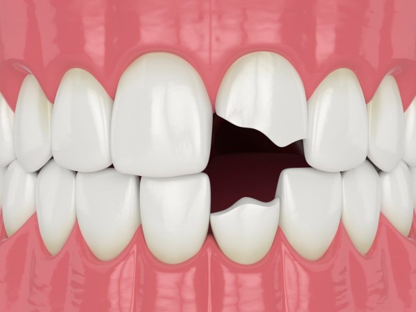 Broken-Tooth.jpeg
